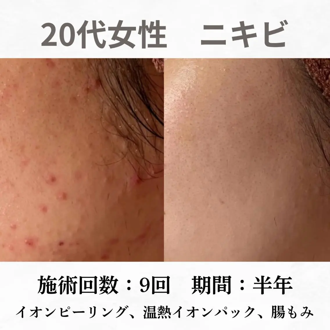 重度ニキビ専門🌷 ダウンタイムなしのエステ・リラクイメージ