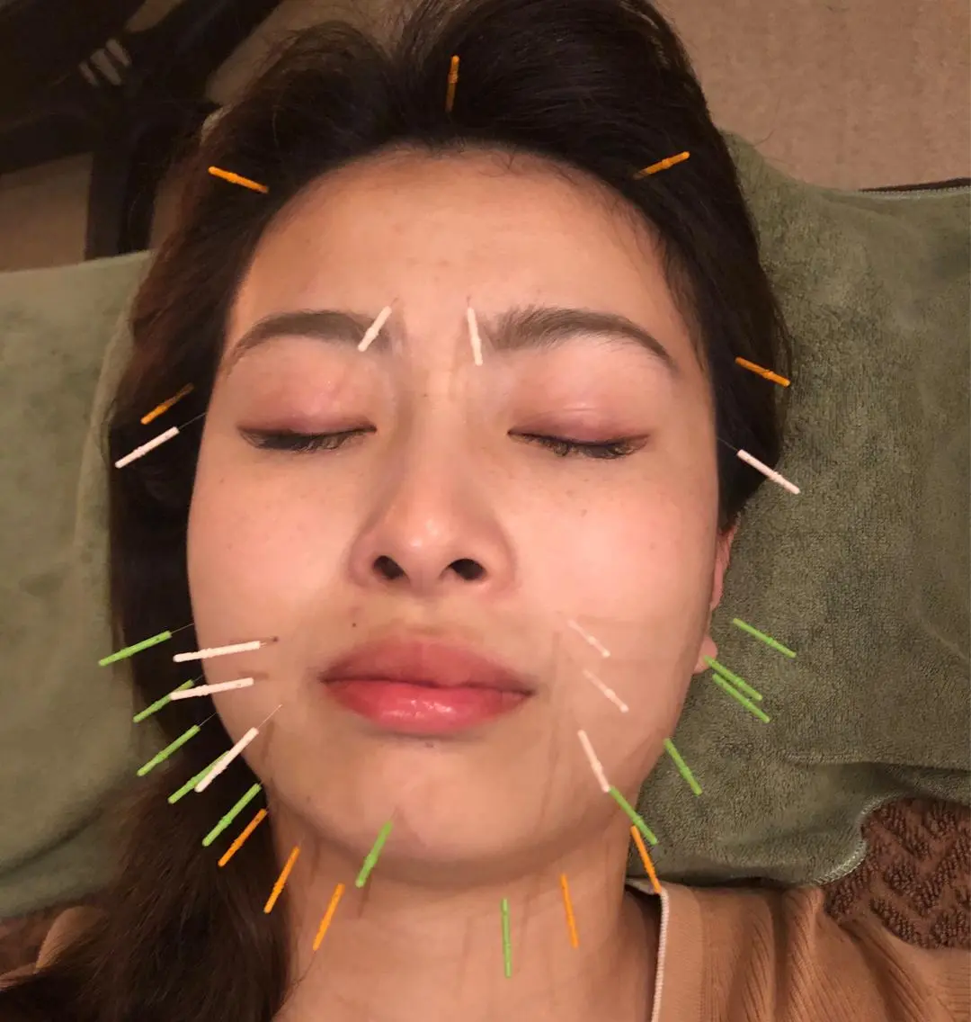 💄リフトアップ小顔鍼💄　　　　　　　　　　　　　　　　　【学生限定🉐🈹】の写真