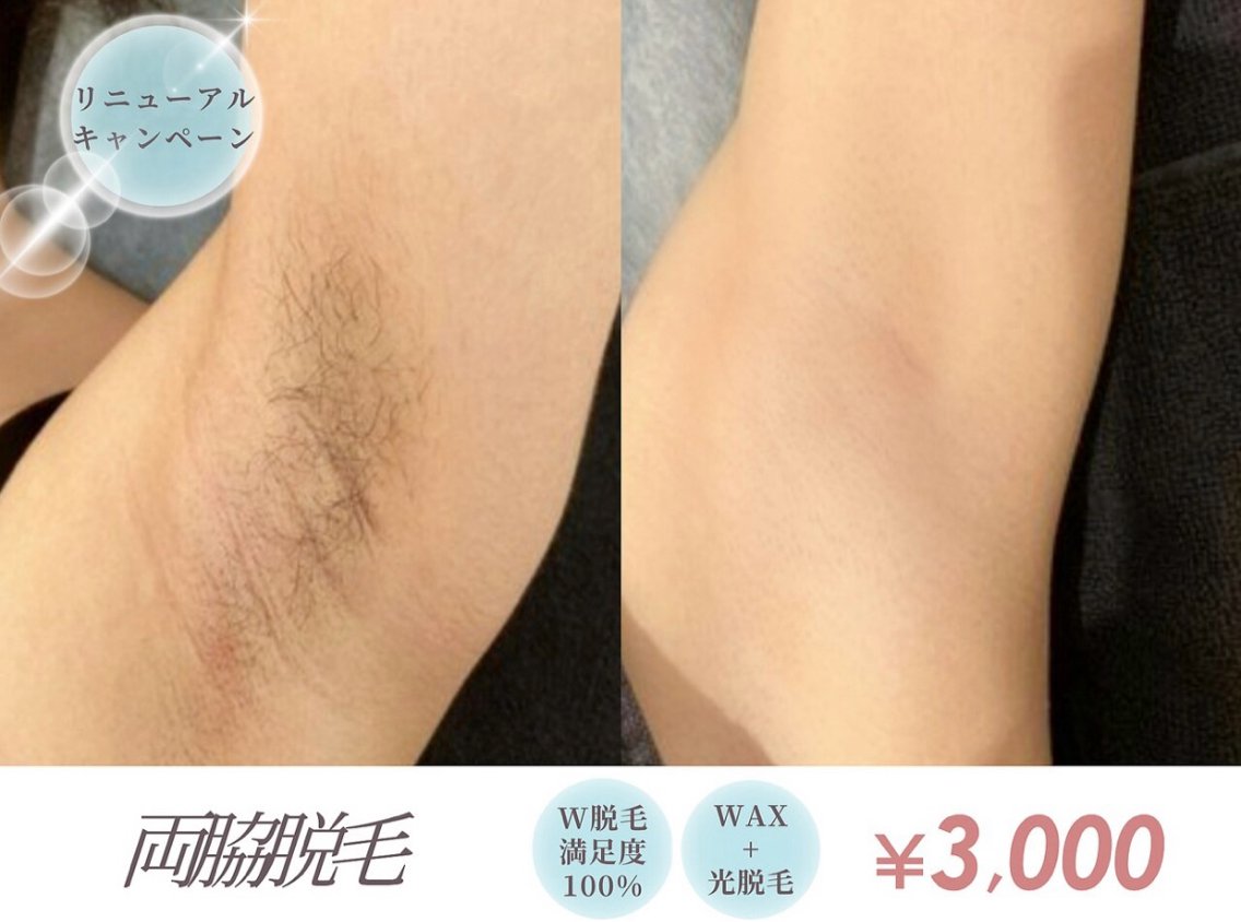 W脱毛【両脇】 女性限定の写真
