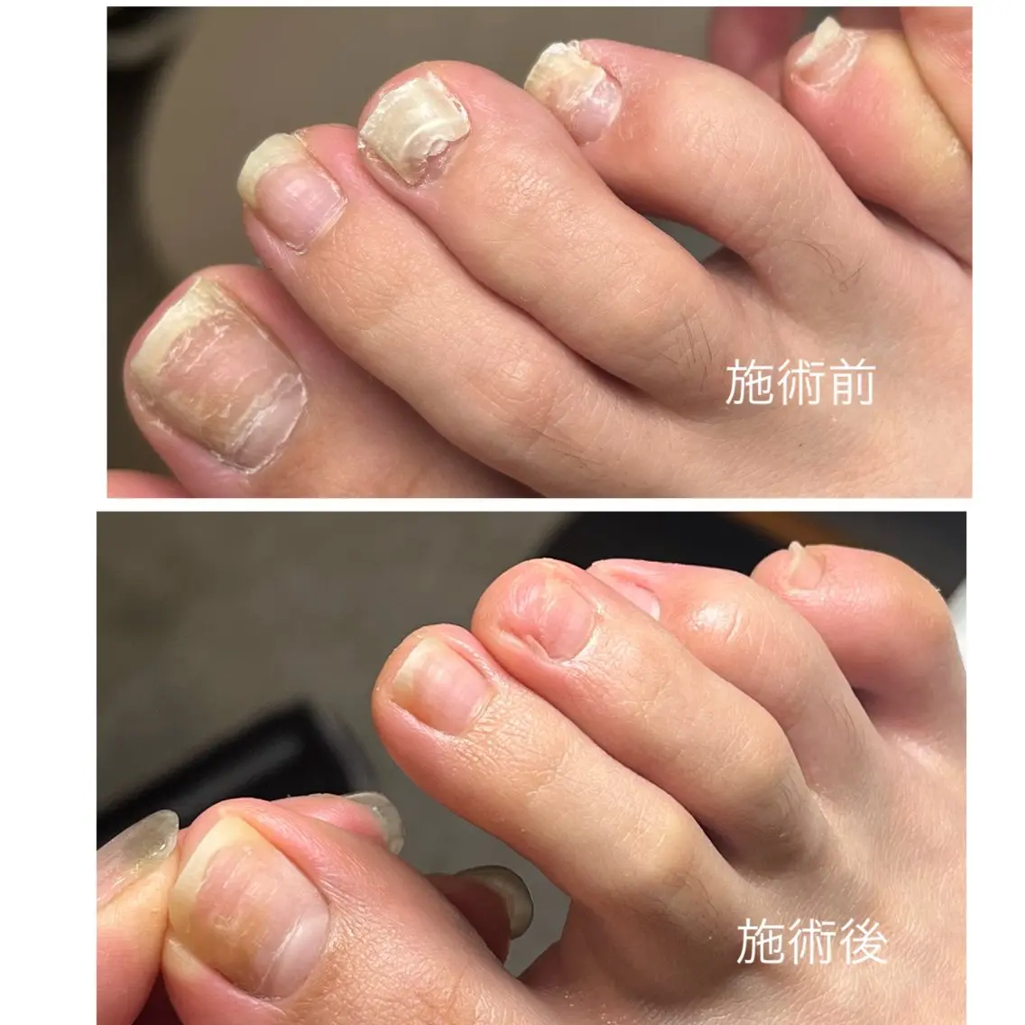 (足の爪)剥離や重複爪等とﾄﾗﾌﾞﾙ専用ﾌｯﾄｹｱの写真