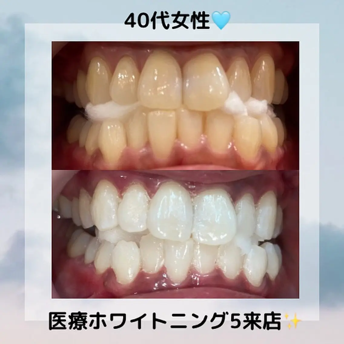 【初回限定】美容ホワイトニング40分（20分×2照射）🦷🩵平均4​〜​8トーンアップ⤴️の写真