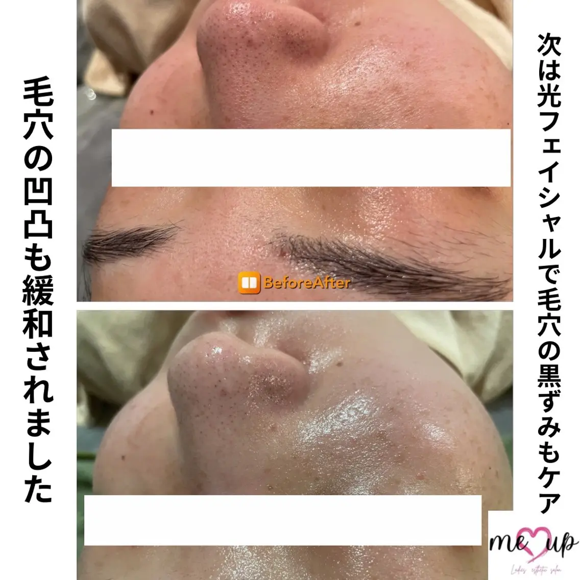 エステ Meupニキビ専門店 背中/ハーブ/肌管理のその他イメージ