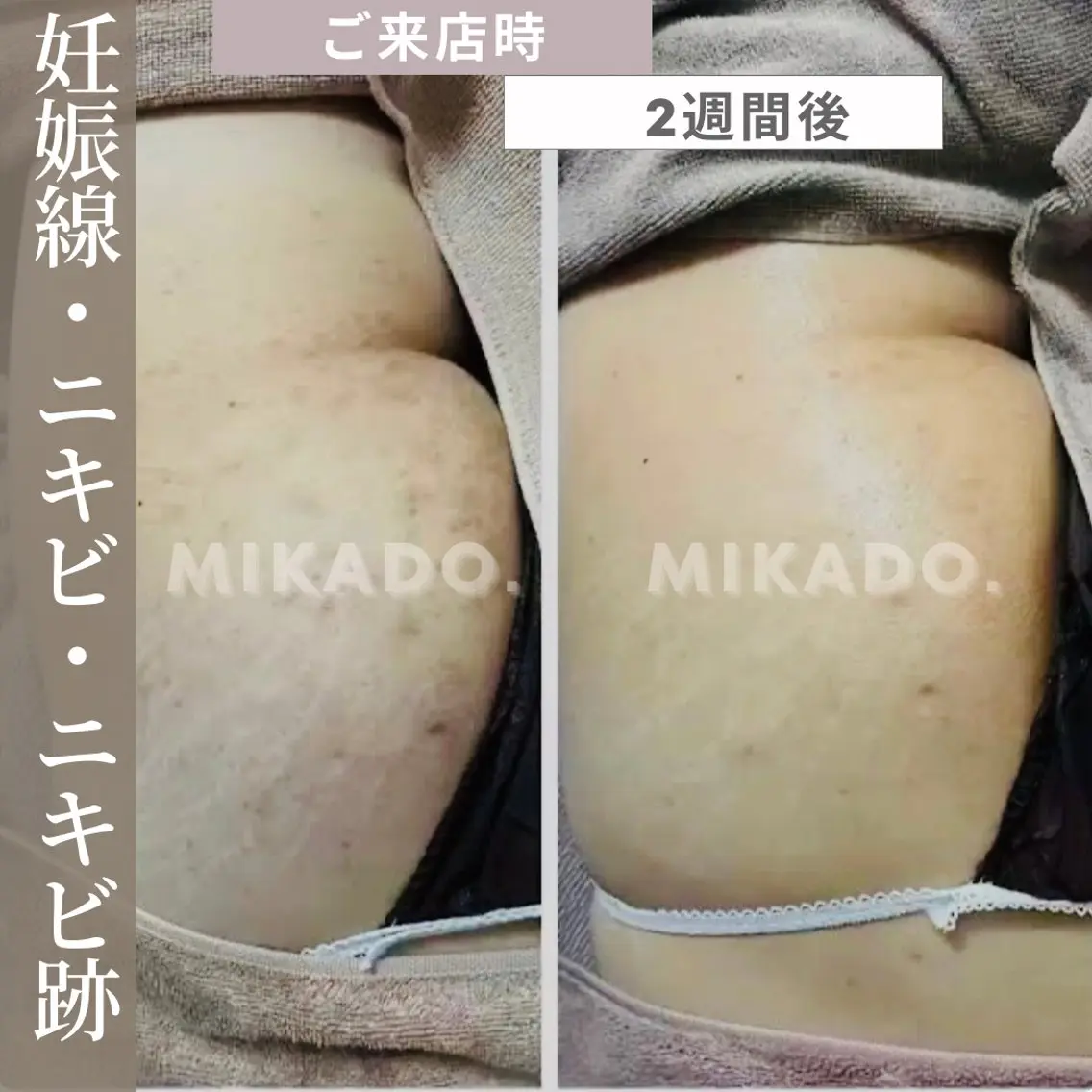 【ハーブピーリングボディー】お尻のニキビケアに!90分¥77000→¥61600の写真