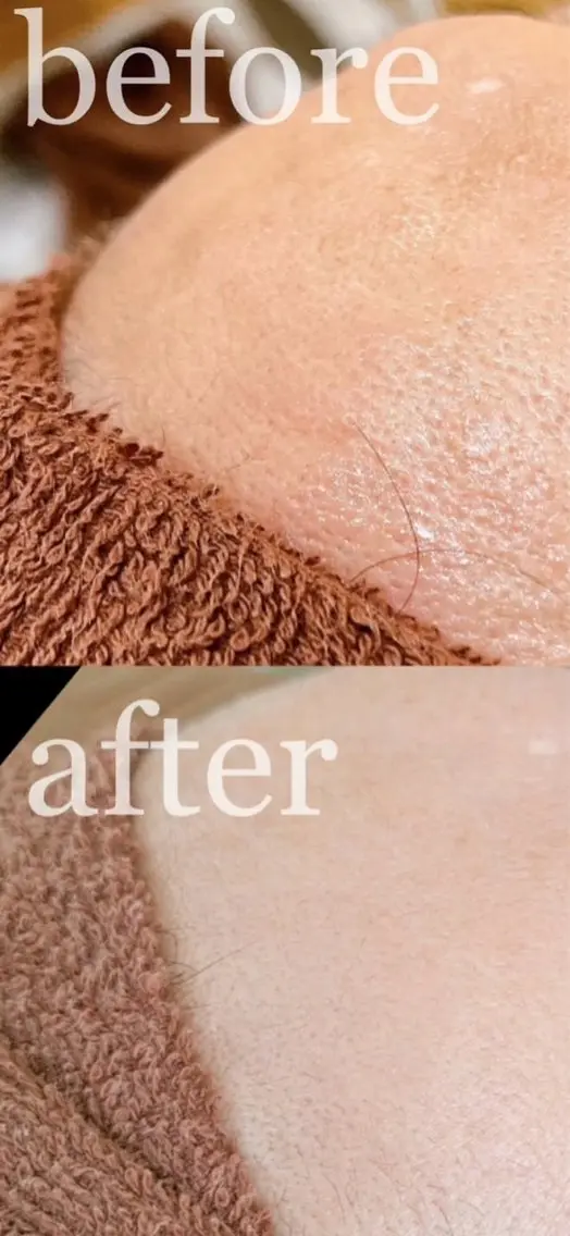 【この施術を初めての方限定】艶肌フェイシャルWAX※必ず説明をお読みくださいの写真