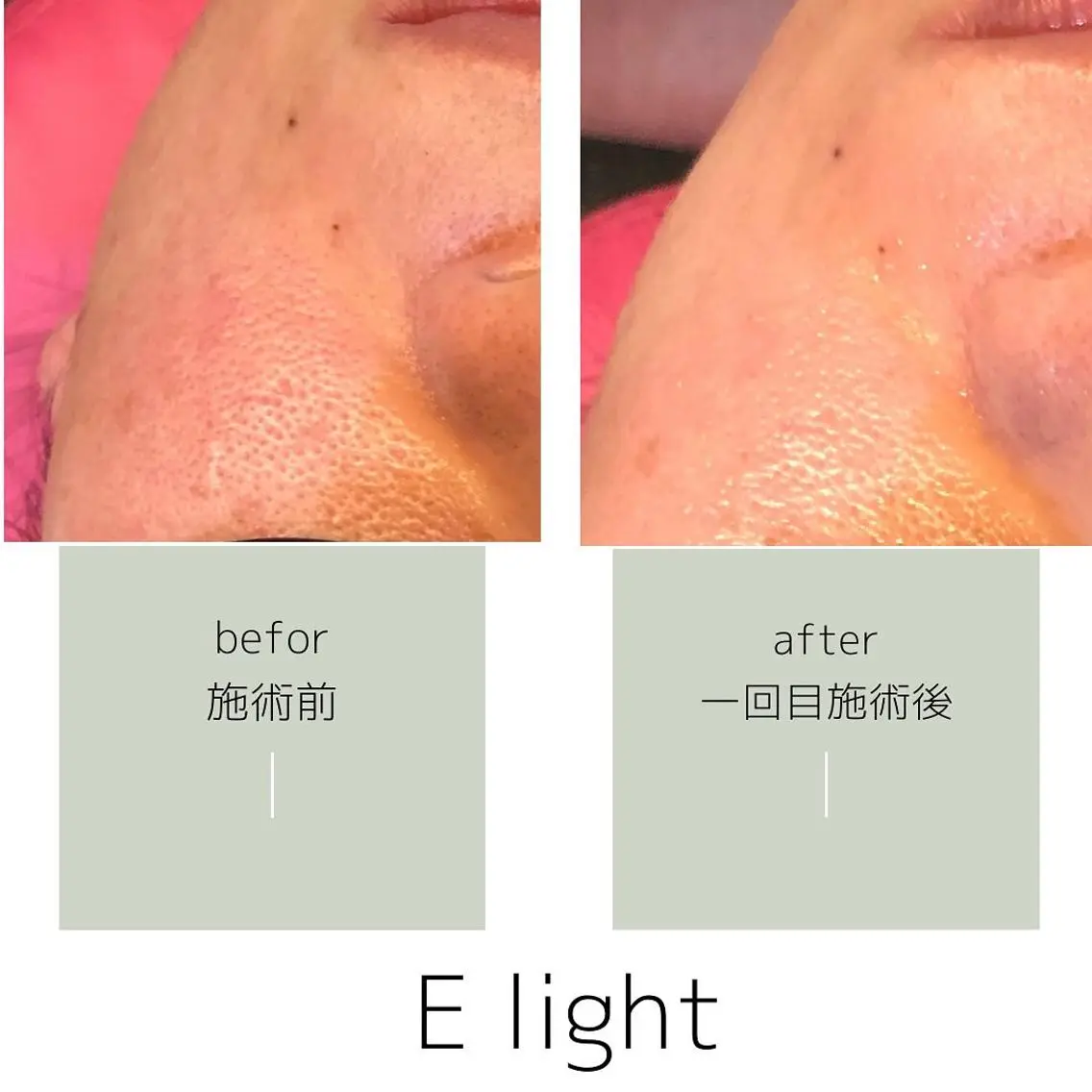 脱毛 salon mijoaのエステ・リラクイメージ