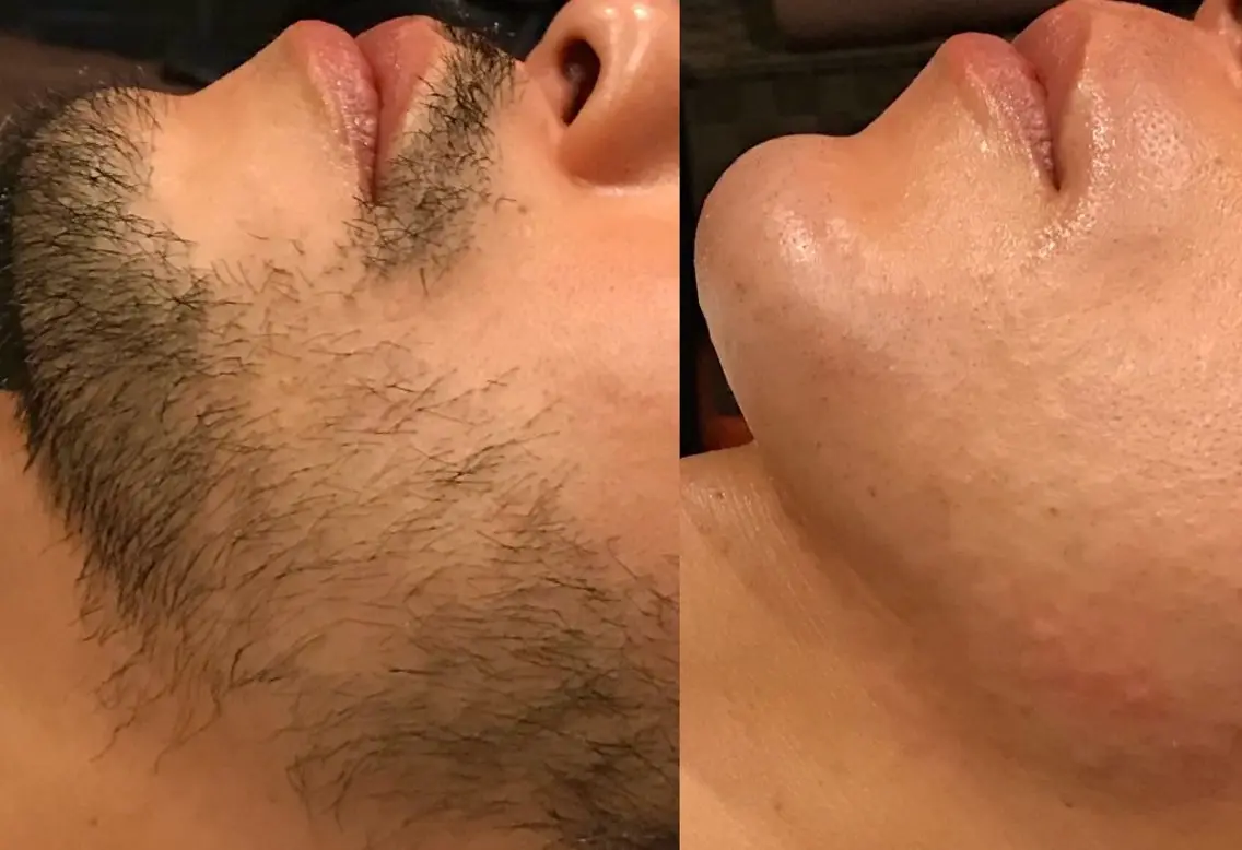 【メンズ】【WAX脱毛】フェイスラインの写真