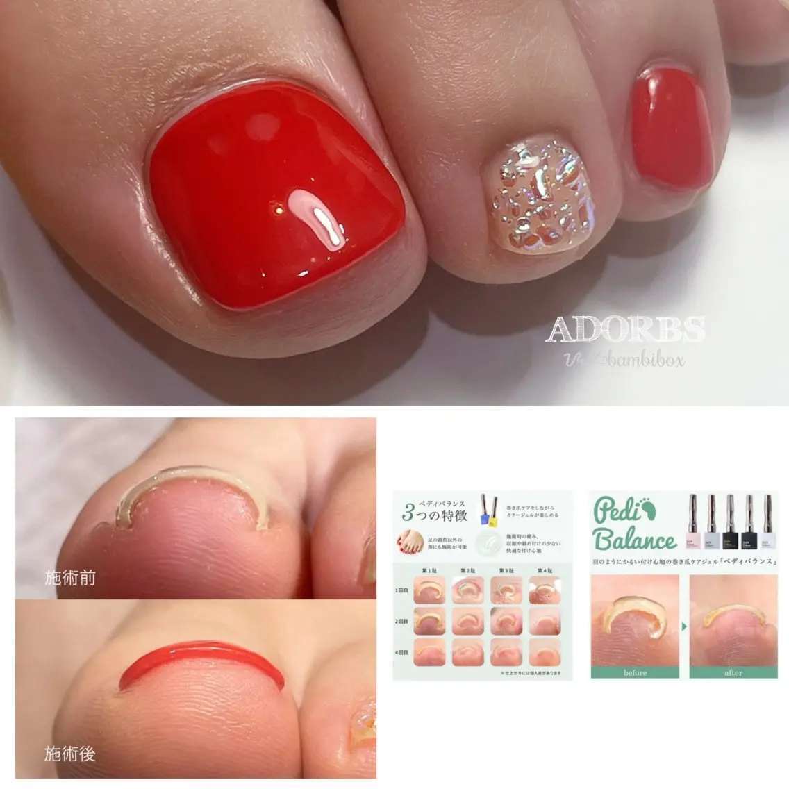 【巻き爪対応ジェルネイル🍏ケア/防止】 巻き爪でお困りの方🦶リフトアップジェル(※当日のご予約は不可)の写真