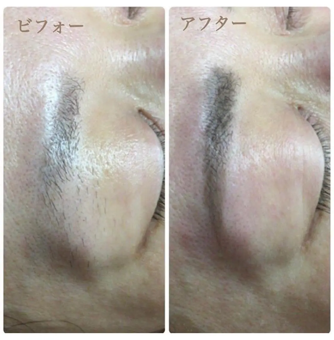 【化粧ノリUP❣️ツルツヤ卵肌🥚】シルク糸産毛脱毛+スクライバー毛穴洗浄+パパイヤパック/部位:全顔の写真
