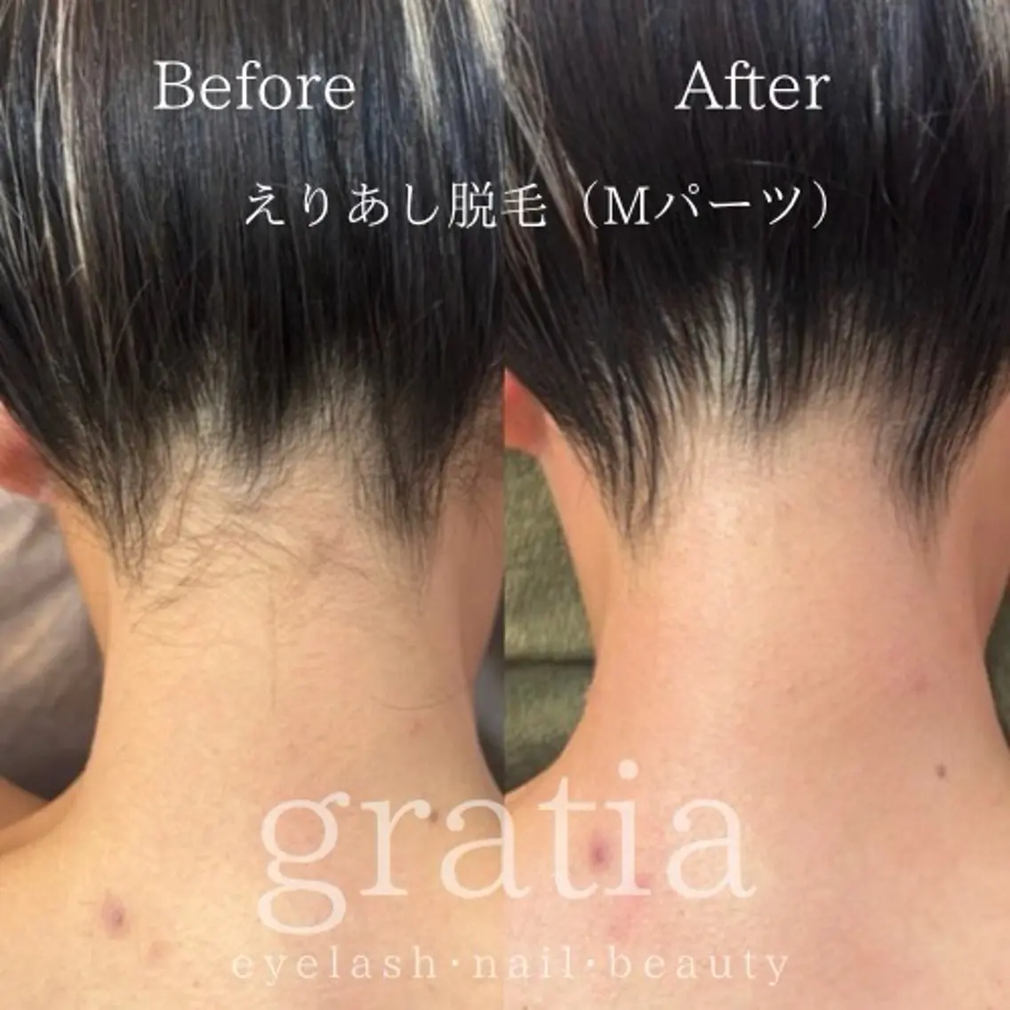 Mパーツ脱毛（えりあし・肘上・肘下・V） 1箇所の写真
