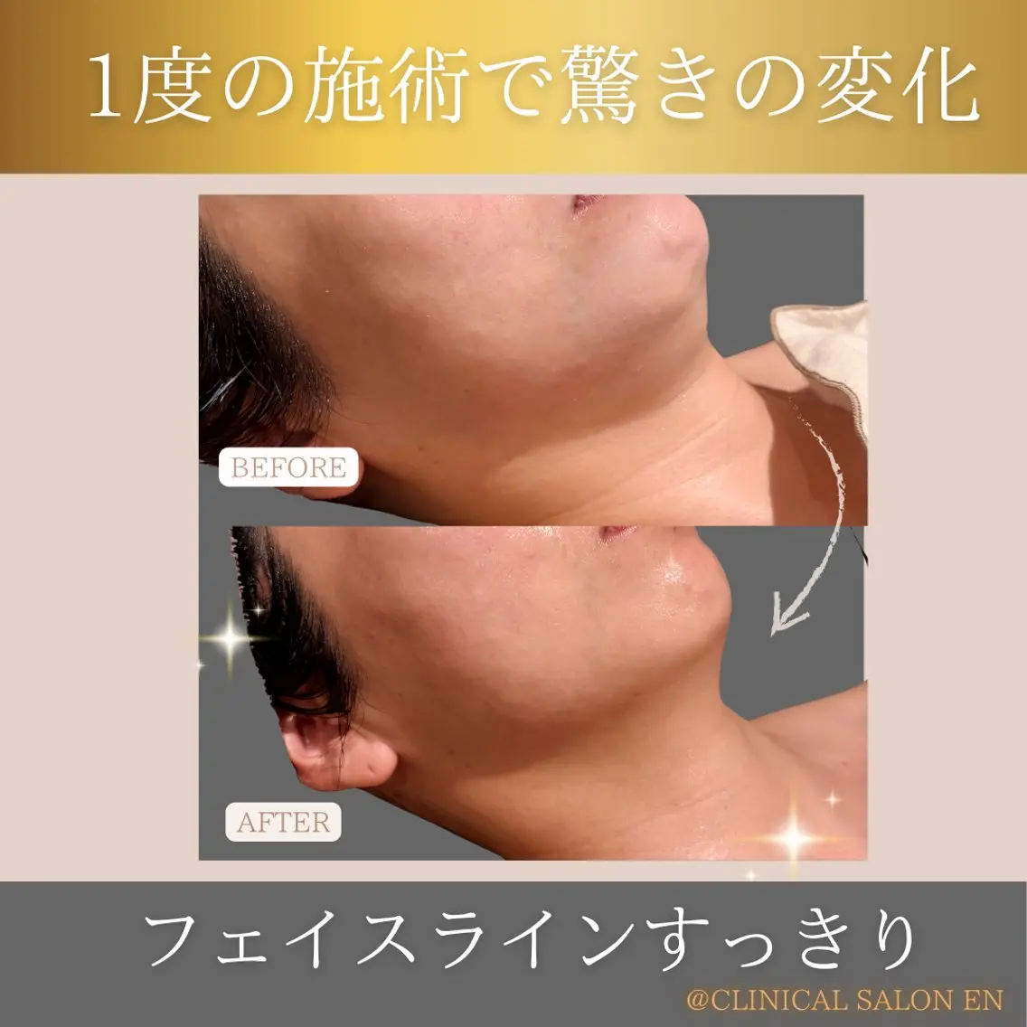 5月限定🌼たるみケアに月一の高周波✨美容クリニックでも主流の高周波マシンをエステサロンでご体験!の写真