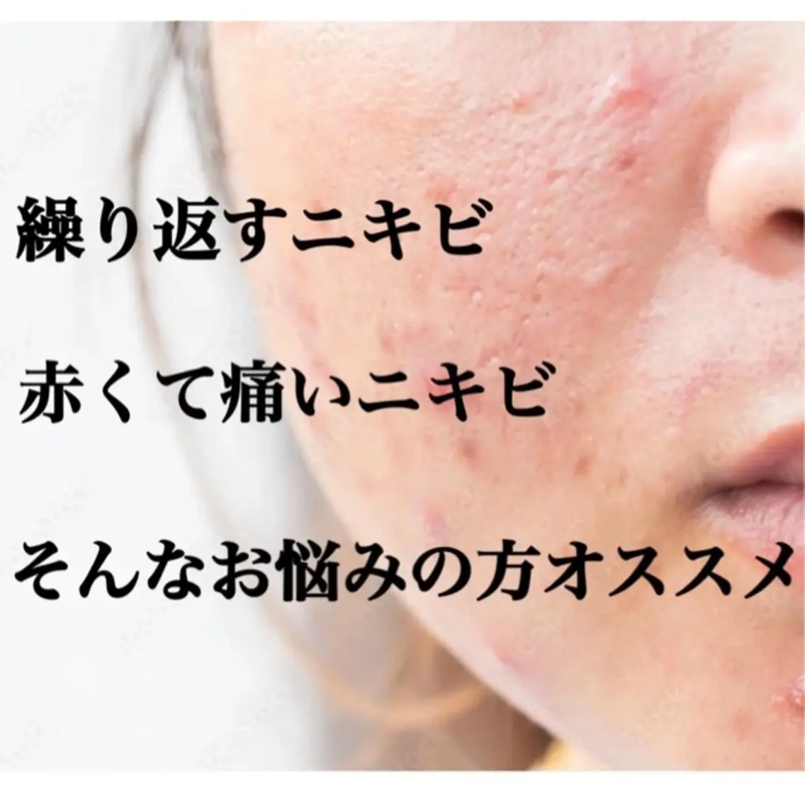 【ニキビ・肌荒れ】全顔毛穴洗浄+アクネ微弱電流導入+保湿パック+ミニモ限定保湿クリーム¥5500※クーポン内容確認の写真
