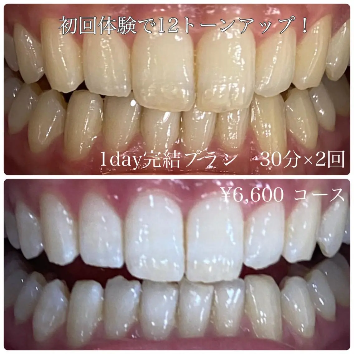 【高校生限定】　セルフホワイトニング　30分🦷✨の写真