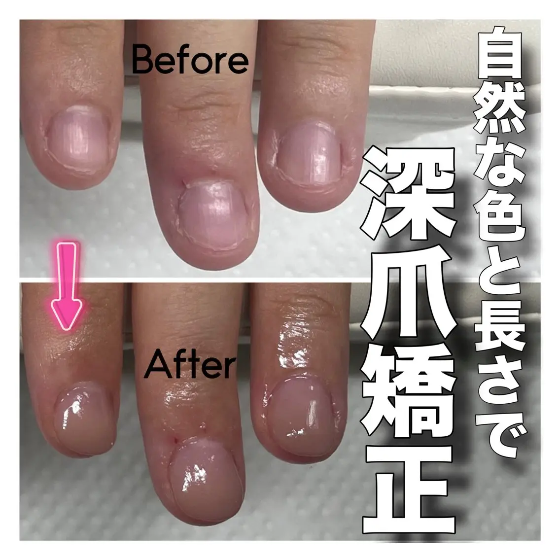 平日限定❤️‍🔥深爪矯正【長さ出し】◆カラーあり◆むしったり割れたり噛んで小さくなってしまった爪も美しく綺麗な状態にの写真