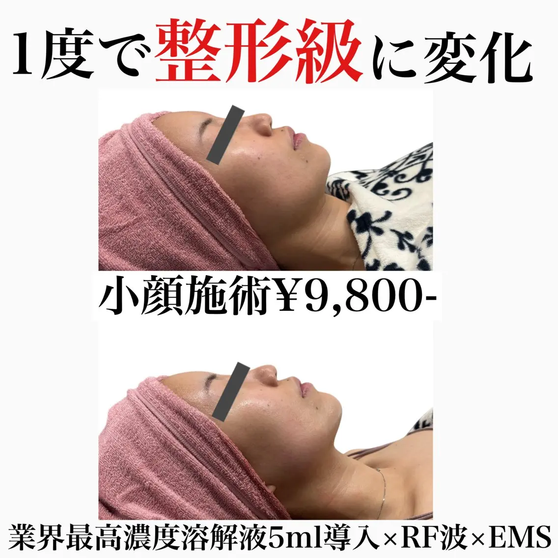 『人気No.1🩷整形級小顔施術』業界最高濃度溶解液5ml導入×RF波×EMSの写真