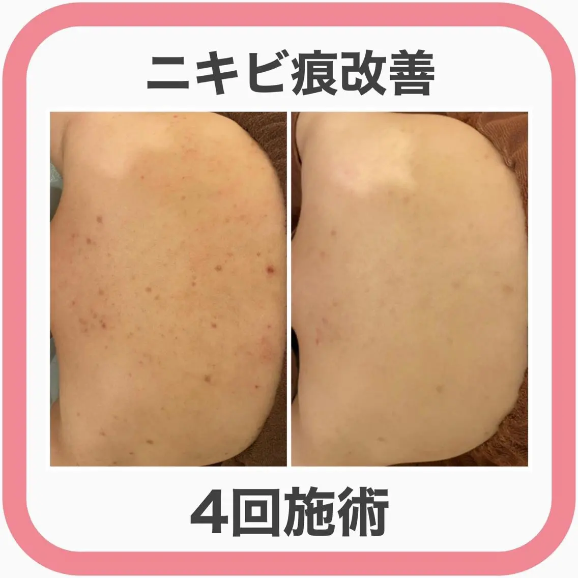 平日限定価格❣️ハーブピーリングより優しい低刺激ピーリング&温熱イオンロウパック🍯お背中の肌荒れ集中ケア🧚✨の写真