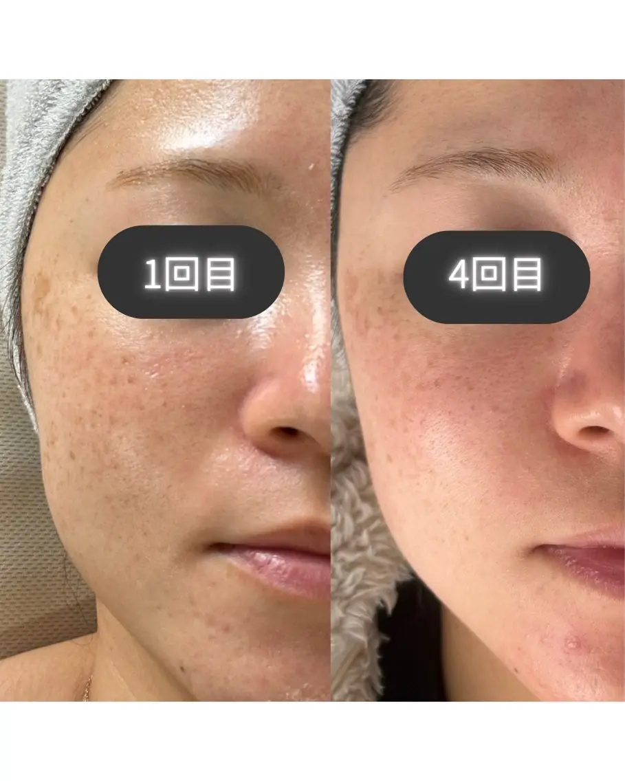 【シミ/シワ/たるみ/毛穴】次世代プラズマ⚡️最強肌質改善◎の写真