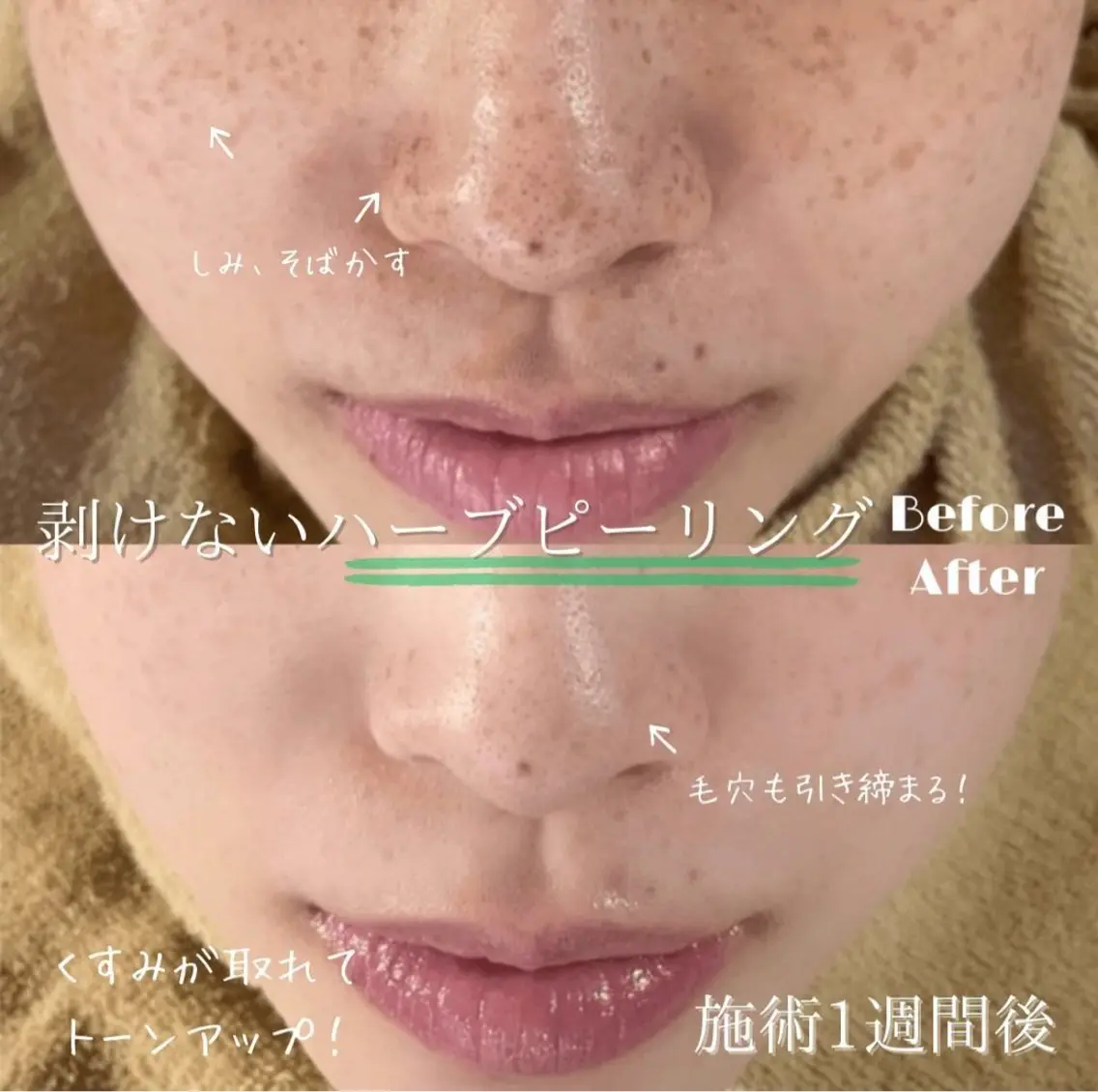 【迷ったらこれ‼️触れたくなる滑らか素肌へ🌿】ハーブピーリングの写真