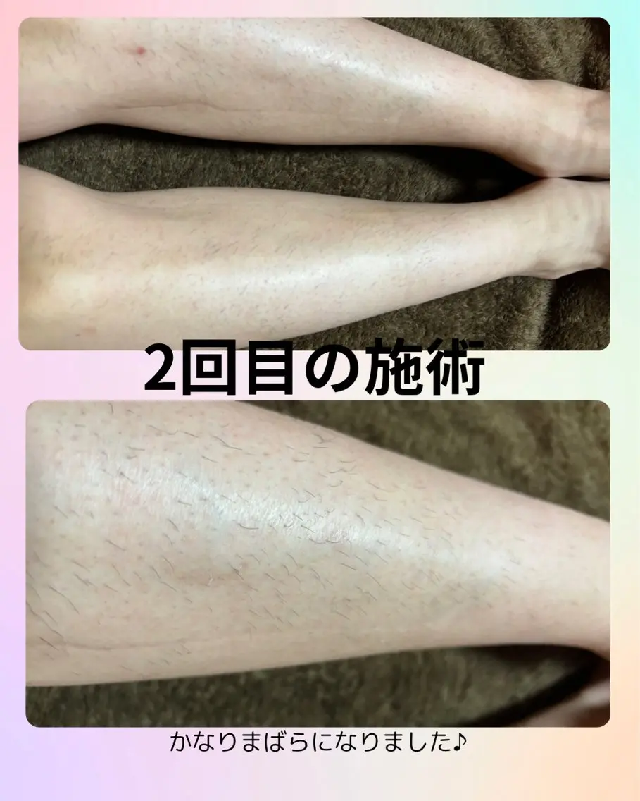 ◆メンズ◆ひざ下つるつるモテ肌(ひざ上なども選択可)の写真