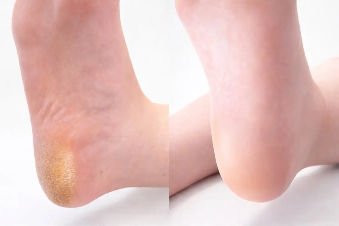【ジェルなしの方】【フットバスケア付き】つるすべかかと🌟足裏角質+フットケアコースの写真