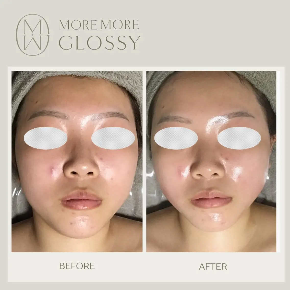 エラの張り、食いしばりのお悩みに特化📣💎眠れる美女コルギ70分/お悩み別に特化した施術で理想のフェイスラインに◎💆の写真