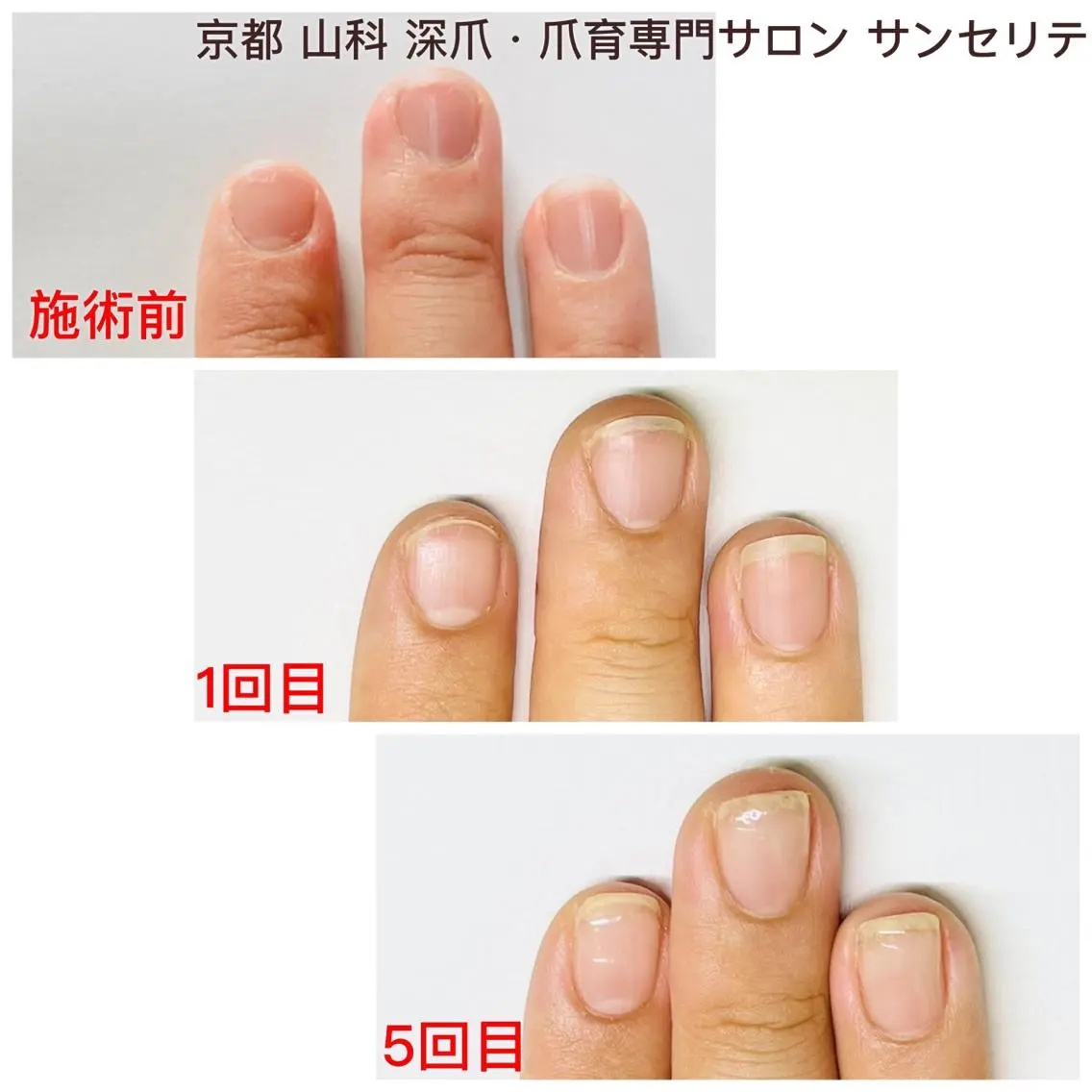ハンドネイル ハンドケア 深爪・巻き爪 専門サンセリテのネイルデザイン