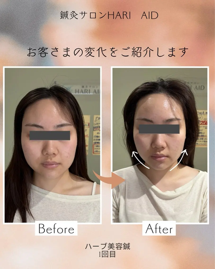 鍼灸サロン HARI  AIDのエステ・リラクイメージ