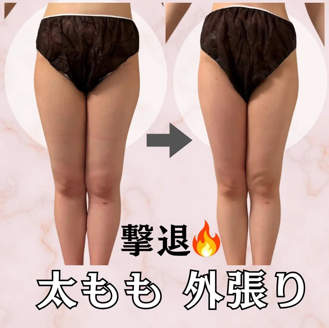 【下半身パンパン】美尻,太もも,膝下を形成◎痩せずらい脚周り90分 「脚が浮腫みやすい」「お尻のたるみ」そんなお悩みに◎の写真