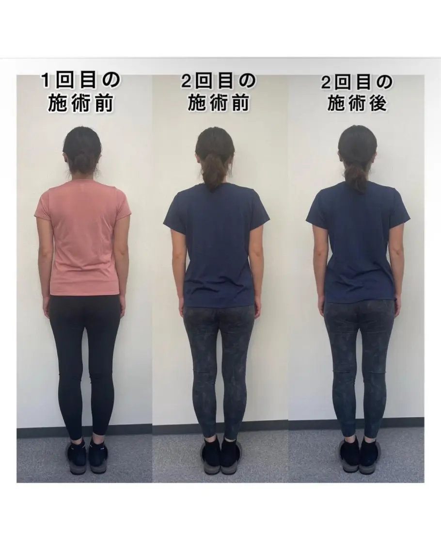 姿勢改善整体の写真