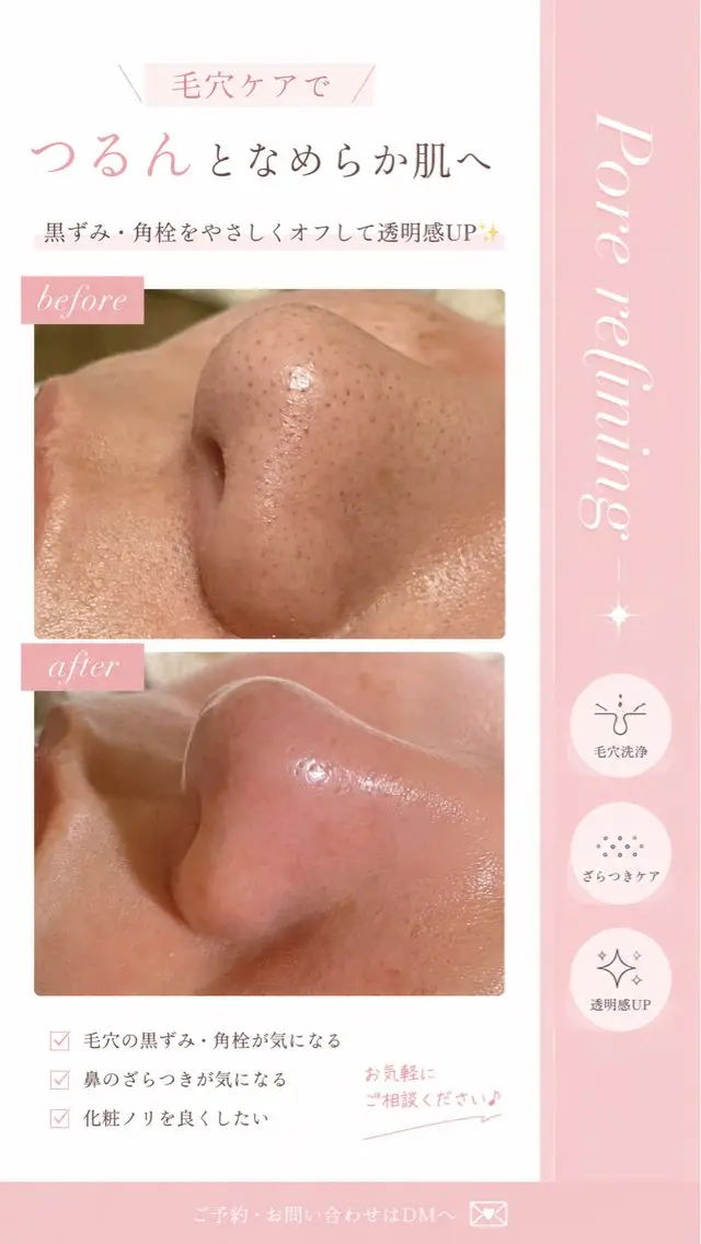 【毛穴悩み】ポアリファインフェイシャル💎8000円→初回7000円✨の写真