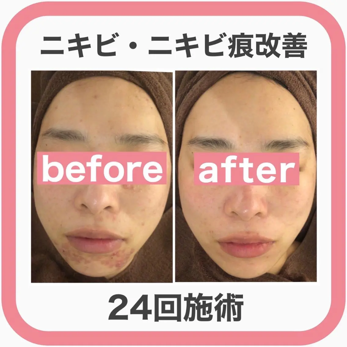 セミロング カラー パーマ ヘアアレンジ メンズ キッズ ネイル マツエク・マツパ アイブロウ エステ リラク 3か月で肌革命👼 ニキビ専門店💫のエステ・リラクイメージ