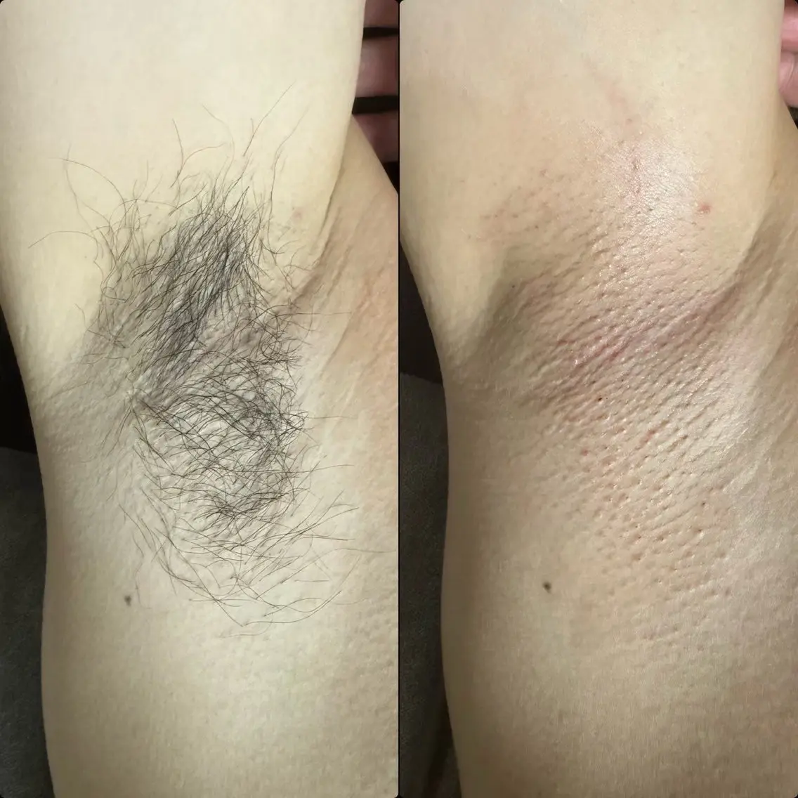 【メンズ👱🏼‍♂️脇】ブラジリアンワックス🍯面倒な自己処理なしでその場でスッキリ✨初めての脱毛デビューにも⭕️の写真