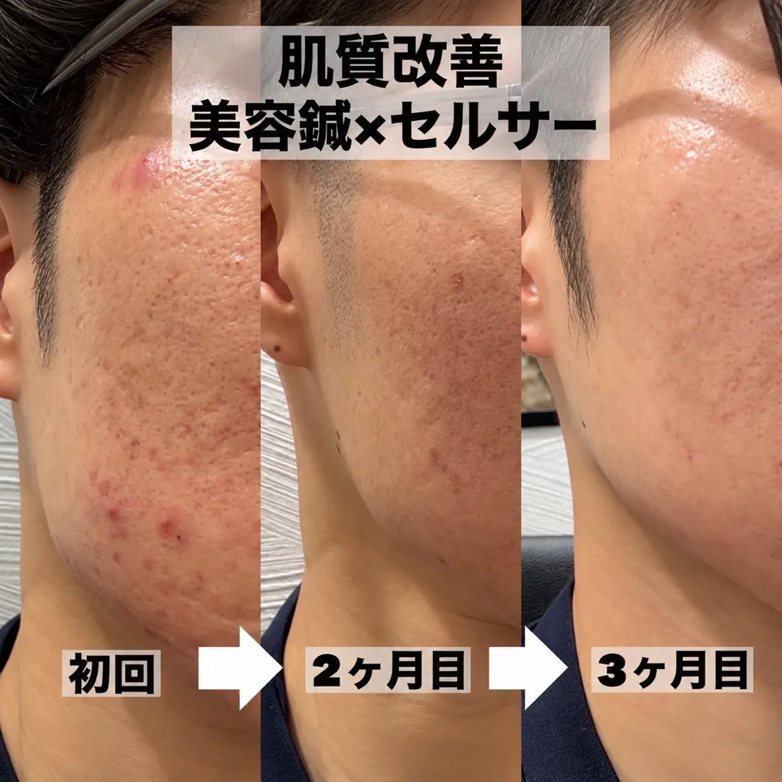 エステ リラク 大阪上本町 肌質改善×美容鍼ゆいのエステ・リラクイメージ