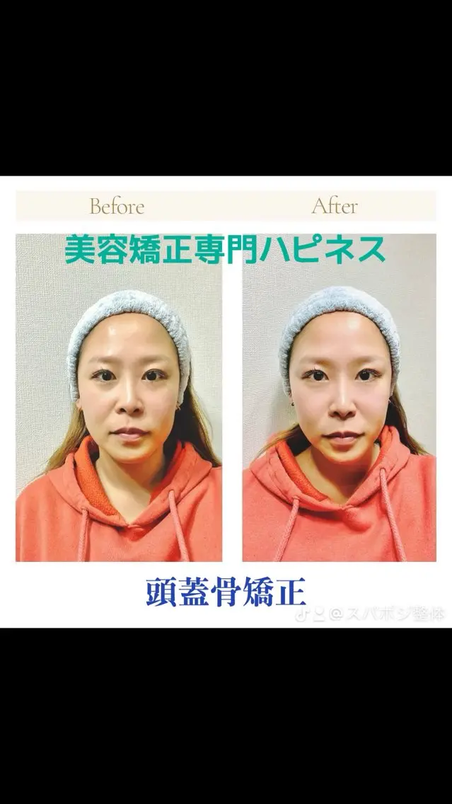 ✨🚗ミニモ限定🚗✨『小顔矯正+頭蓋骨矯正+美顔リンパ』目鼻立ちくっきり!誰もが憧れる小顔に🌟 『施術60分』の写真
