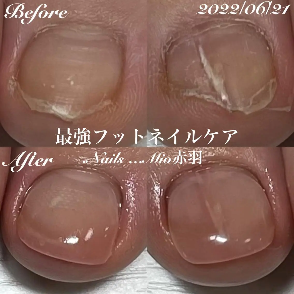 👣スポーツネイル損傷爪ケア1本30分の写真