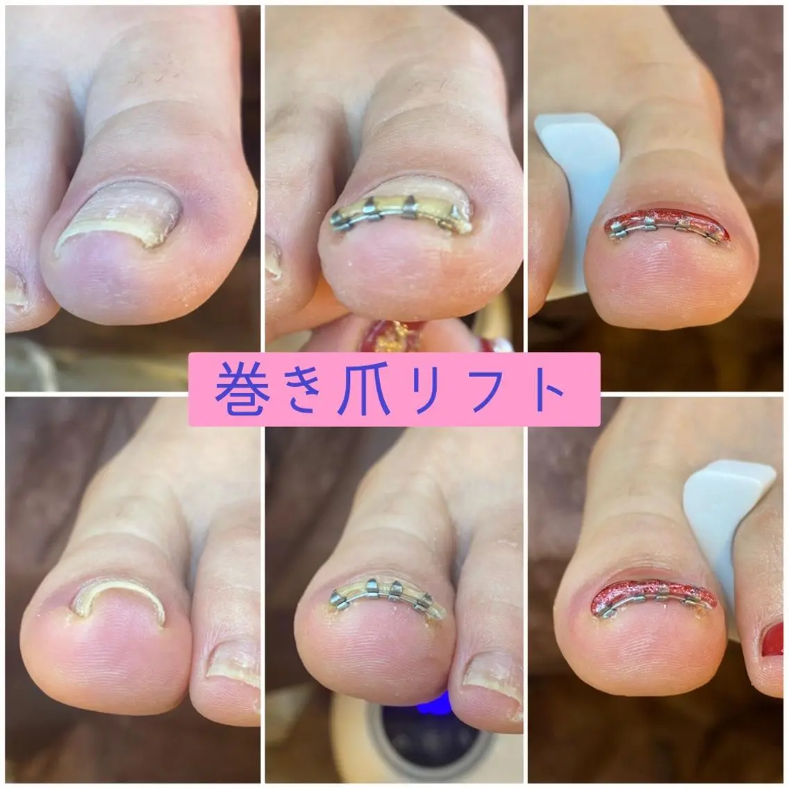 ネイル ♢ME2ROOM♢ #巻き爪#リラクのネイルデザイン