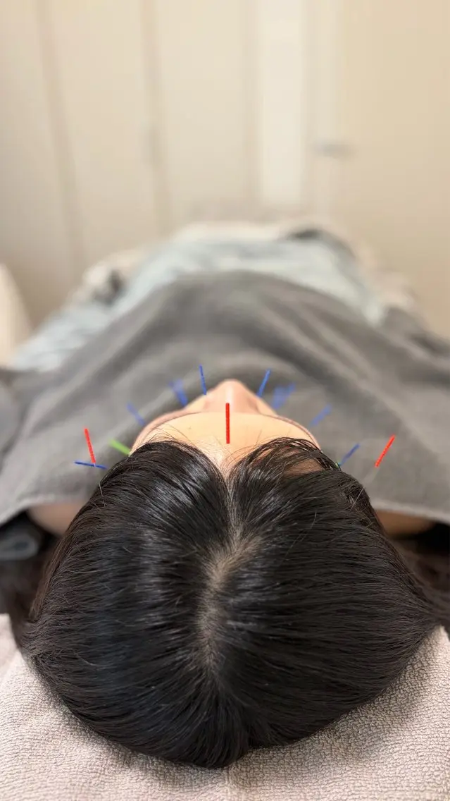 美容鍼(お顔+お体)の写真