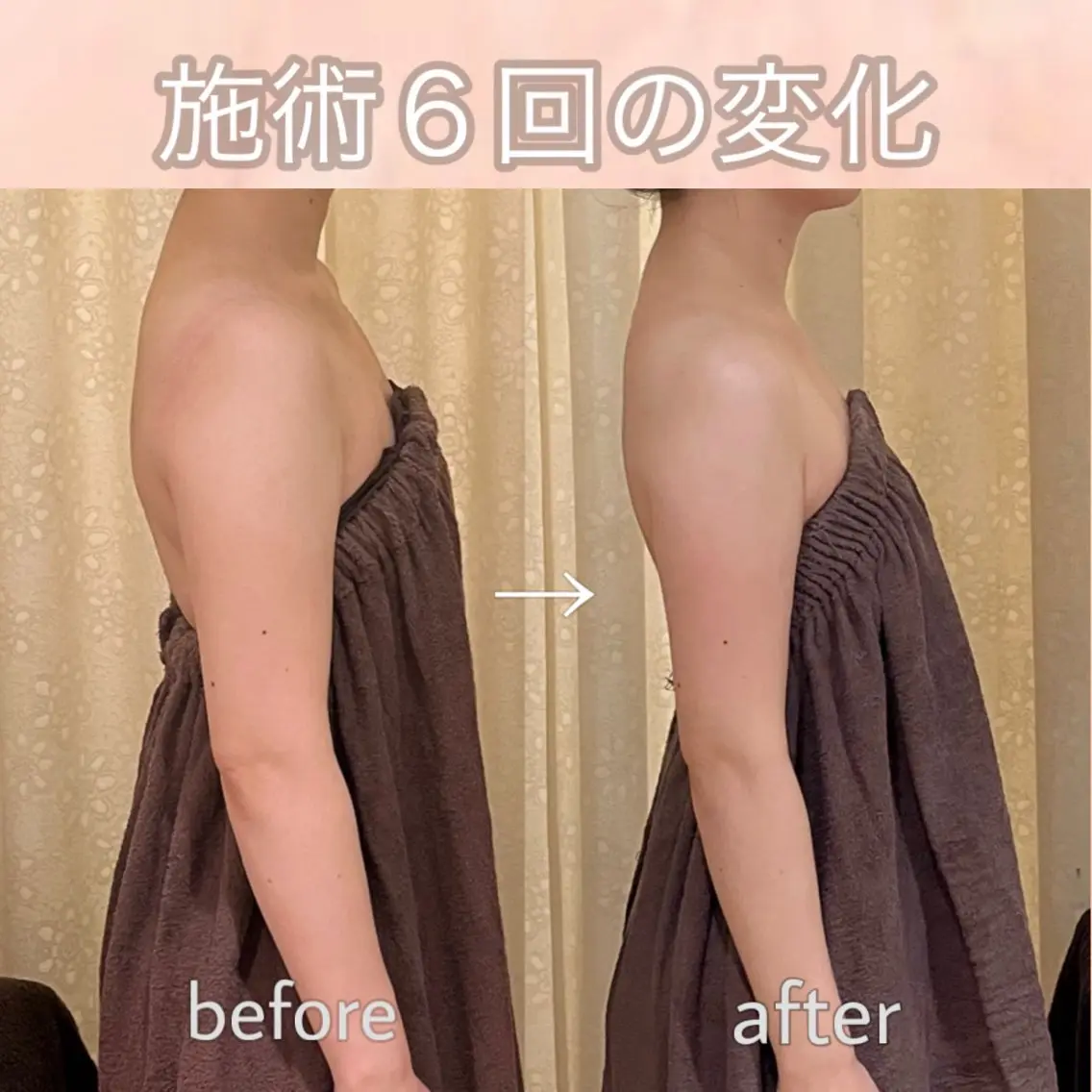 【背中・二の腕】ドレス映え集中ケア✨華奢見えコース60分の写真