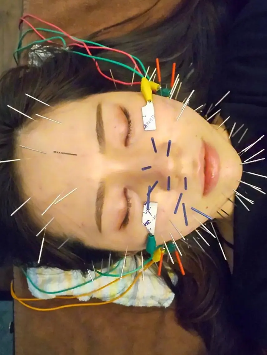 ミニモ限定！春限定！あなたの肌の悩みを解決します！美容鍼を体験しようの写真