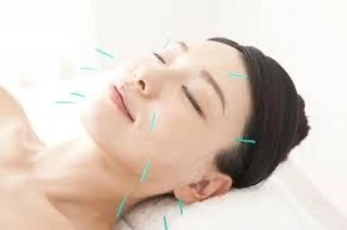 美容鍼 の写真