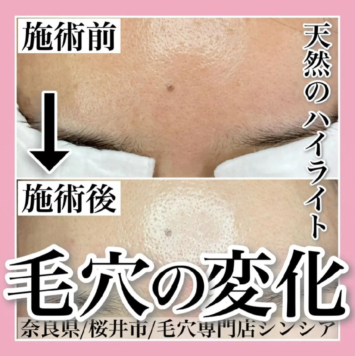 メンズ メンズハイライト エステ 毛穴ケア専門店 Cynthiaのエステ・リラクイメージ