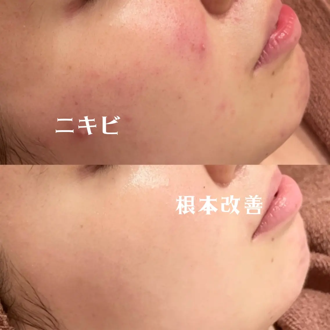 【当日直前SALE❕❕✨】肌負担0ピーリング&温熱イオンパックでニキビ撃退コース❕❕🤎の写真