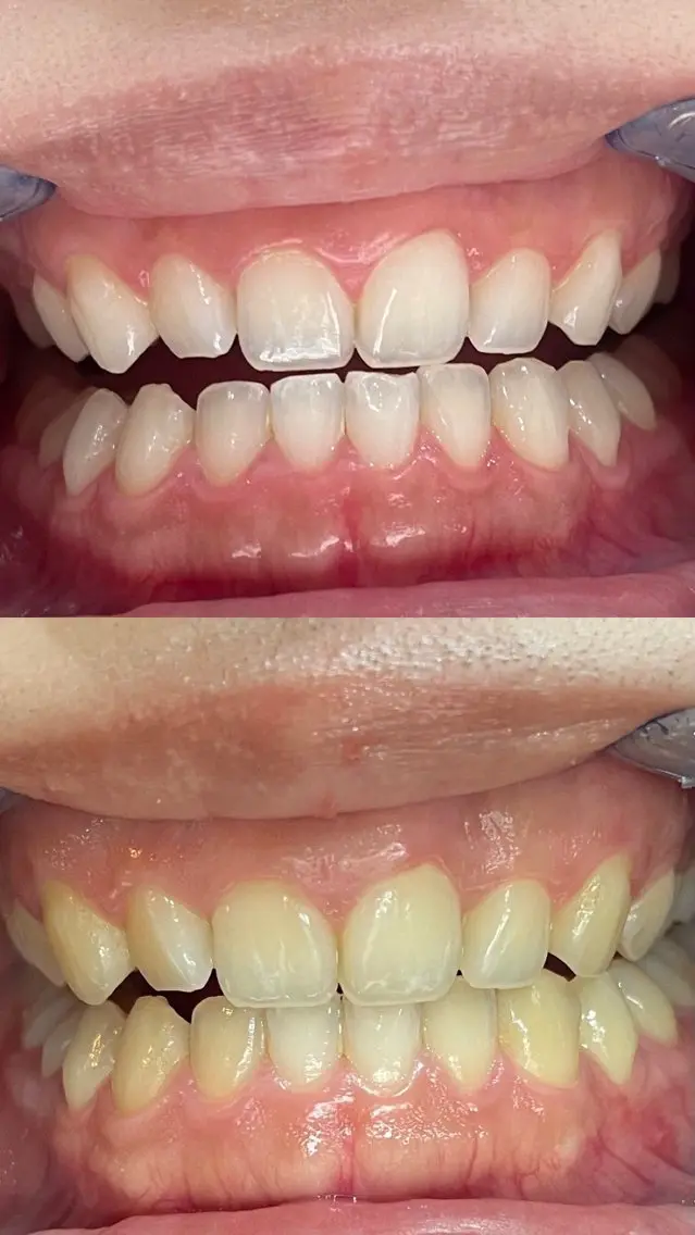 その他 セルフホワイトニング 都立大学🦷✴︎のその他イメージ