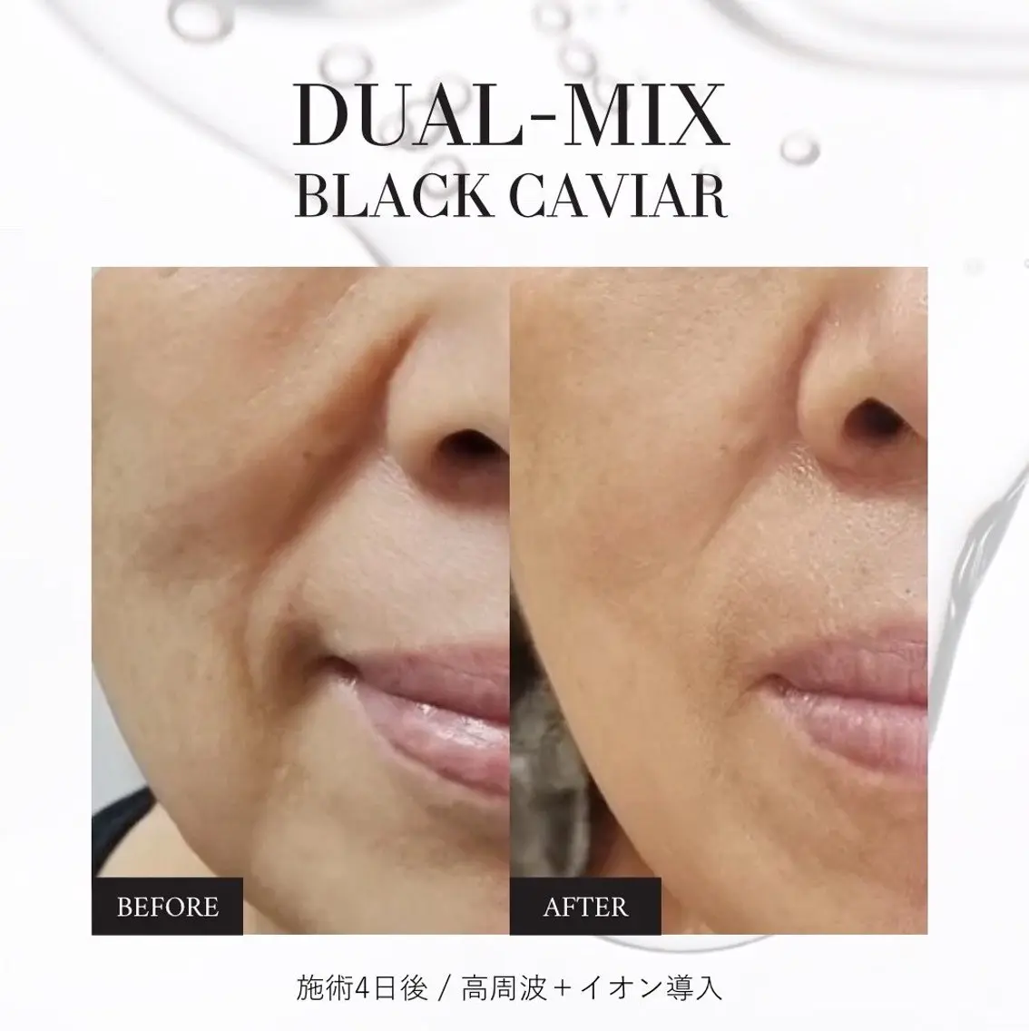 【ミニモ限定】5名様限定！表情ジワ集中ケア！ハリ復活フェイシャルエステの写真