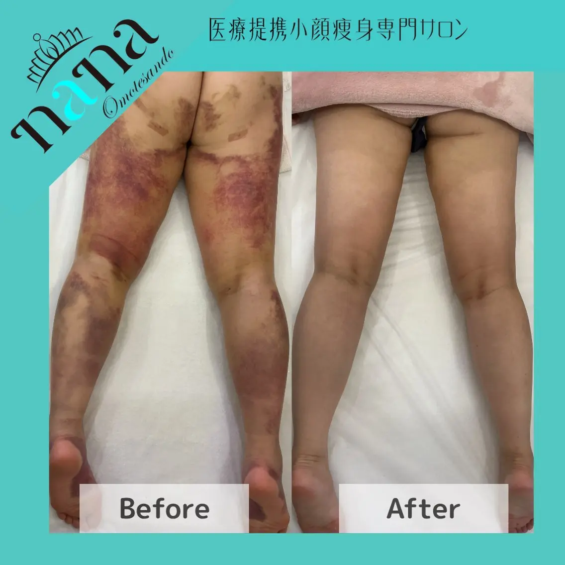 【美容施術前&後】ボディ(お顔とバスト以外)のむくみ・こわばりを丁寧にケア|高周波温熱機器でしっかりケア◎90分コースの写真