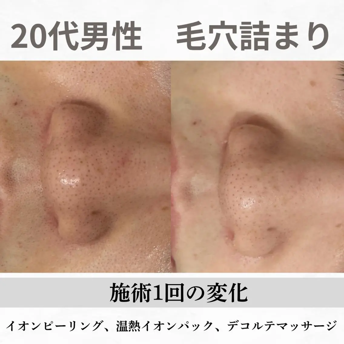 重度ニキビ専門🌷 ダウンタイムなしのエステ・リラクイメージ