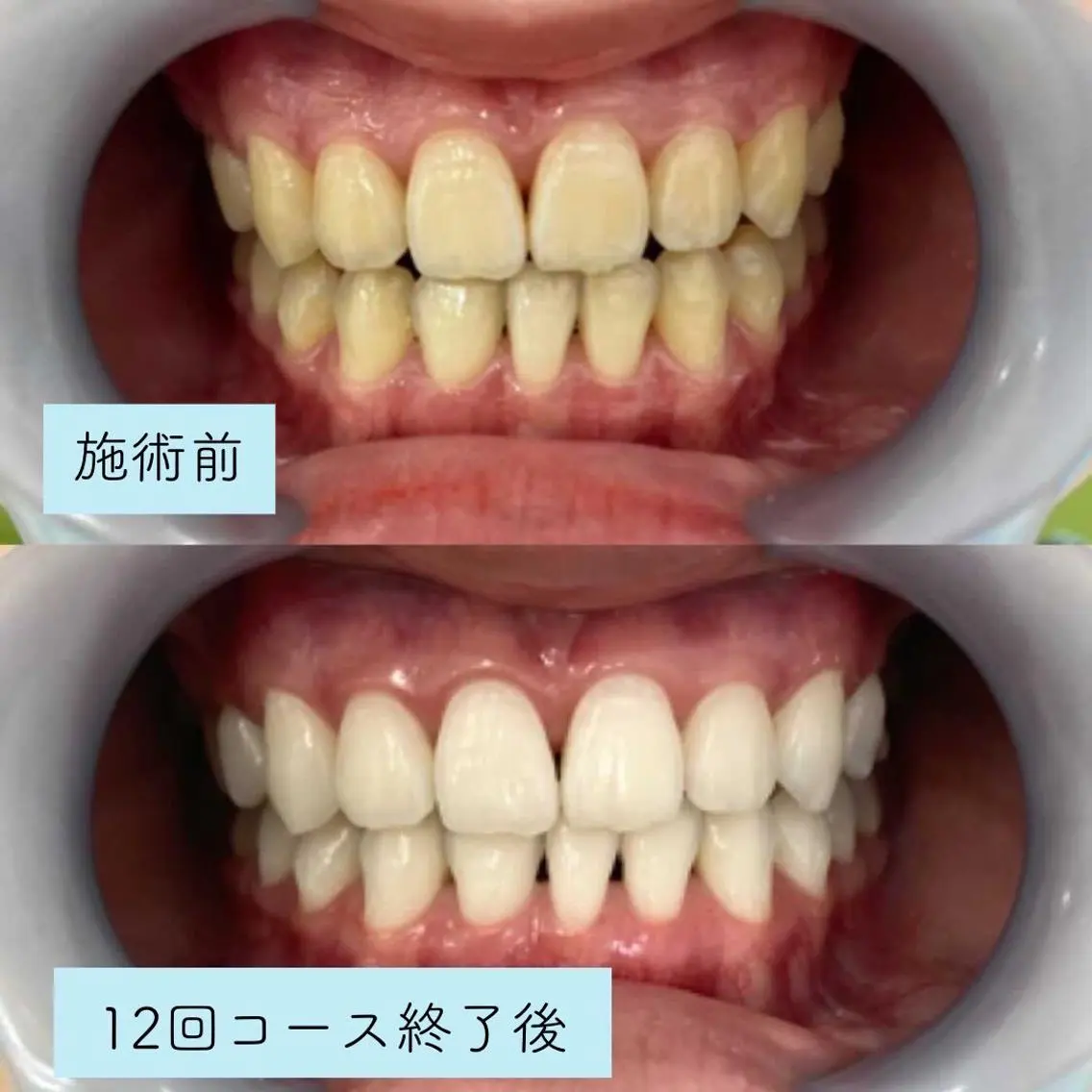 【歯を白くしたい方】医療ホワイトニング✨18000→条件付き1980円or8800円→1980円で受けれる!の写真