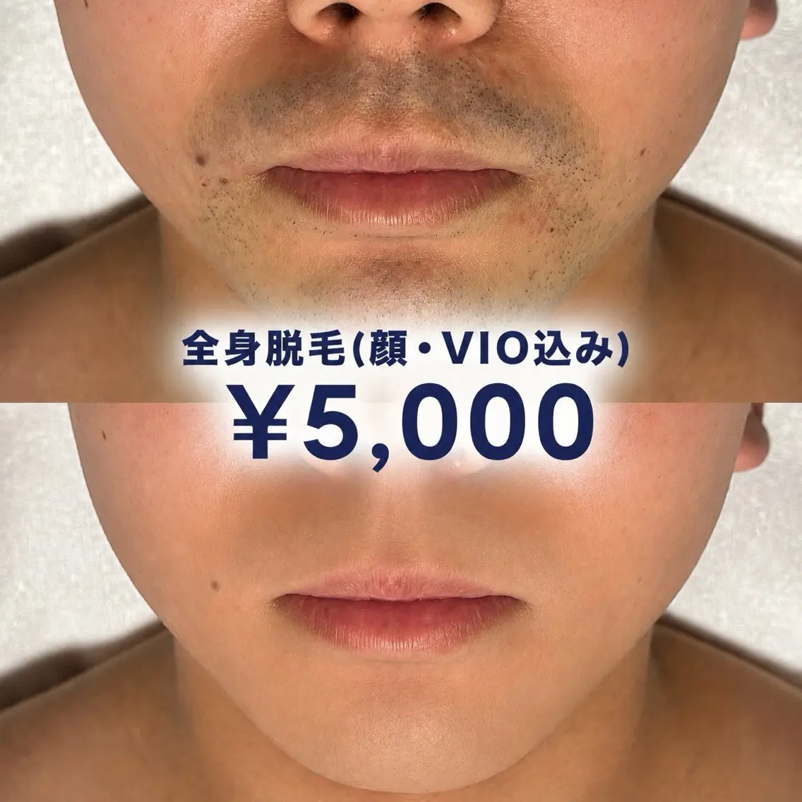 【メンズ限定クーポン⭐︎】全身脱毛(顔・VIO込み) ¥5,000の写真
