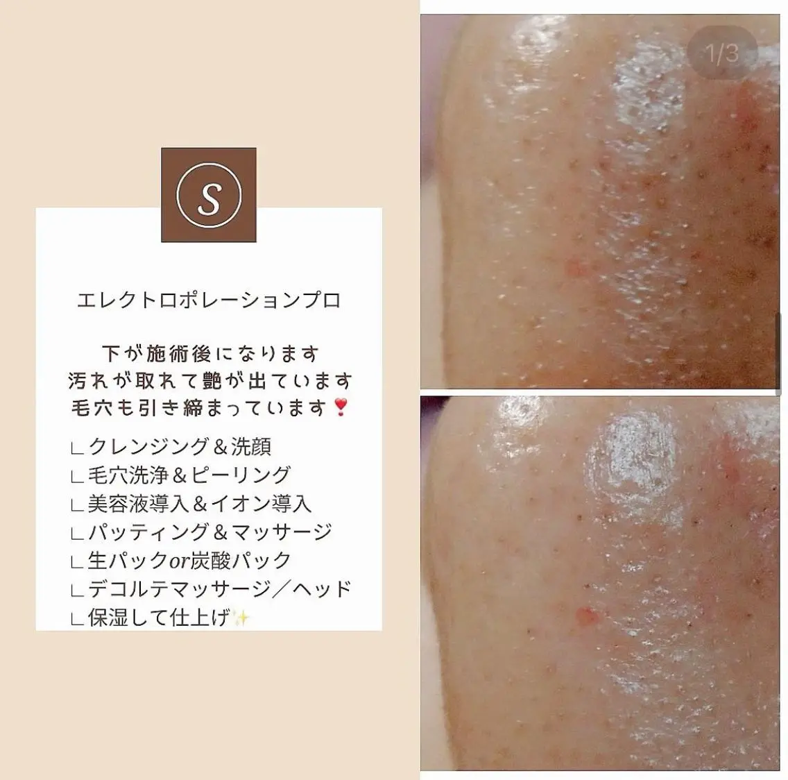 エレクトロポレーション　毛穴改善の写真