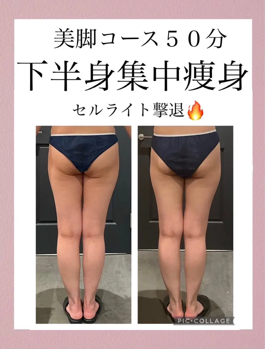 【ミニモ限定】痛いからこそ効く頑固なセルライトとさよなら、脚痩せ50分コース⭐︎の写真