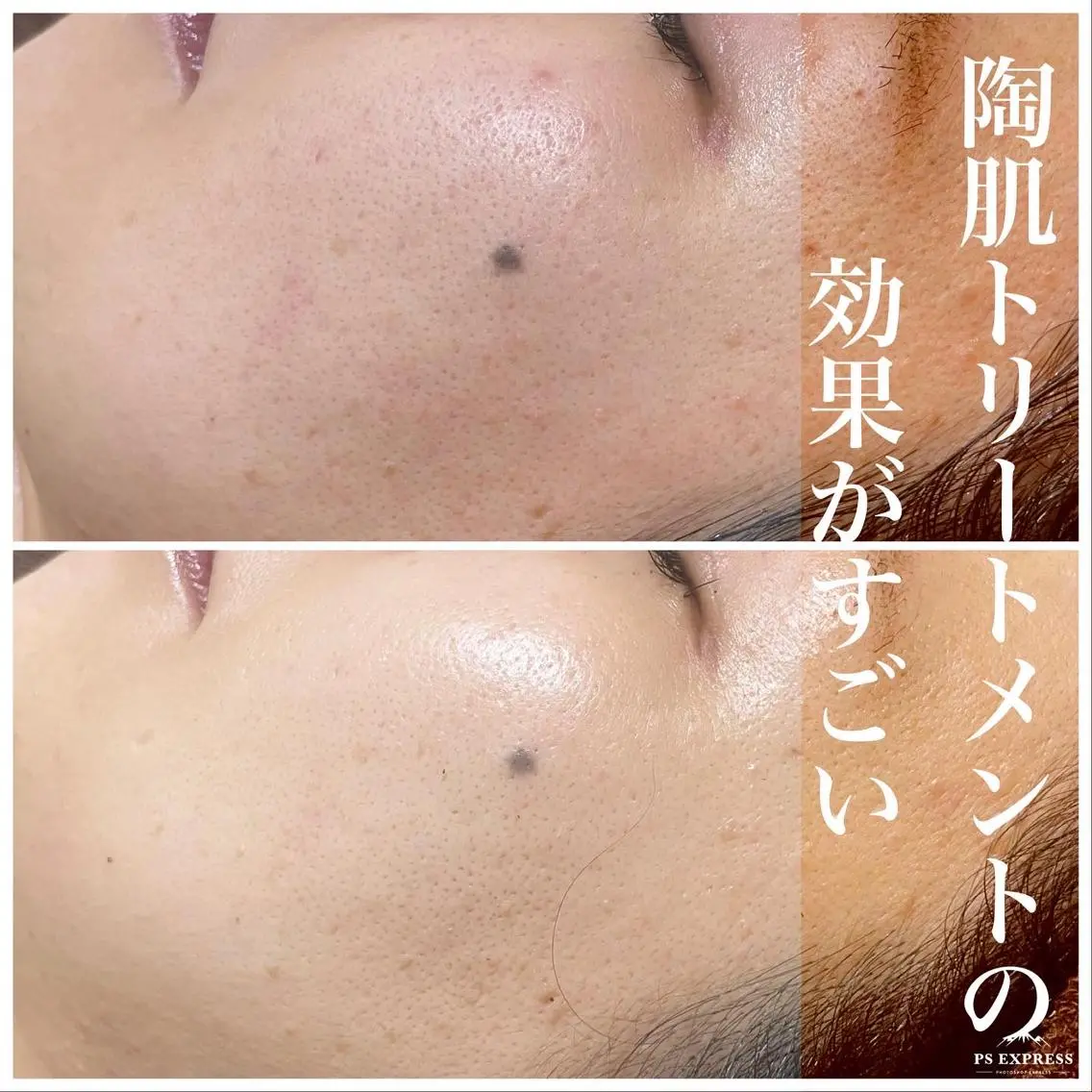 【頑固なニキビ・敏感肌・シミシワケア】剥けないハーブピーリング+カスタム美容液2つ付き 定価22550円の写真